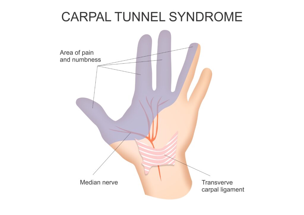 carpal tunnel syndrome