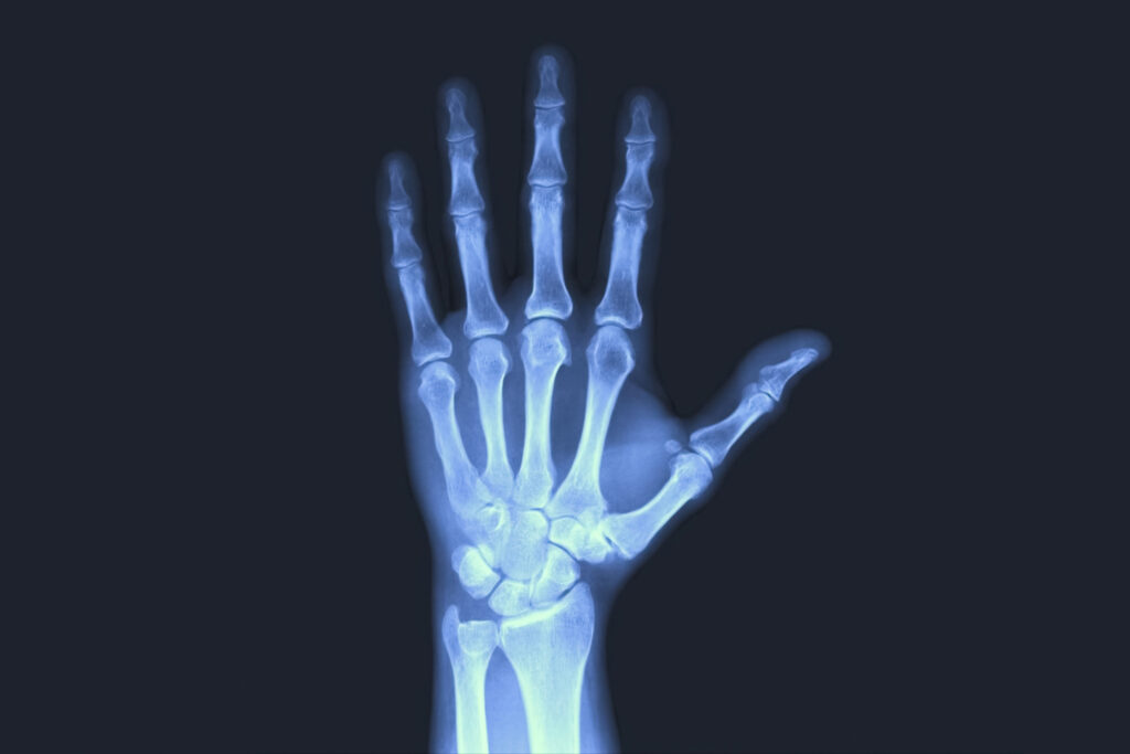 X-rayed human hand. X-ray of hand bones