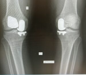 Partial Knee Replacement
